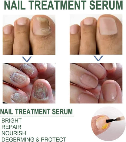 Fast Nail Fungus Remover